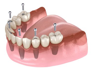 Çikletli çene protezi. Hepsi de implantlarla desteklenen 6 sistemde. İnsan dişleri ve protez kavramının tıbben doğru üç boyutlu çizimi