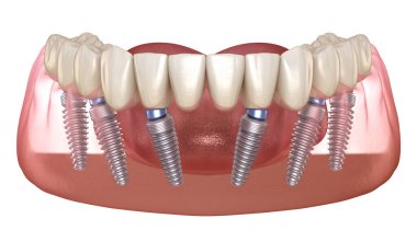 Çene protezi. Hepsi de implantlarla desteklenen 6 sistemde. İnsan dişleri ve protez kavramının tıbben doğru üç boyutlu çizimi