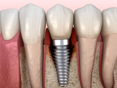Görülebilir kemik hasarlı perisiplantit. Diş implantı kavramının tıbben doğru üç boyutlu çizimi