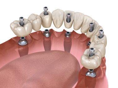 Çikletli çene protezi. Hepsi de implantlarla desteklenen 6 sistemde. İnsan dişleri ve protez kavramının tıbben doğru üç boyutlu çizimi