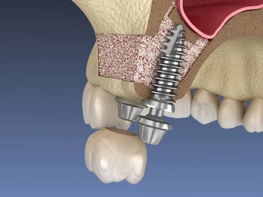 Sinüs gerdirme cerrahisi - implant kurulumu. 3B illüstrasyon