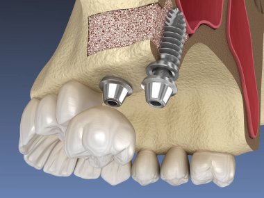 Sinüs gerdirme cerrahisi - implant kurulumu. 3B illüstrasyon