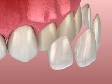 Merkezi kesici diş ve yan kesici diş üzerinde vener kurulum prosedürü. Tıbbi olarak doğru diş 3D illüstrasyon