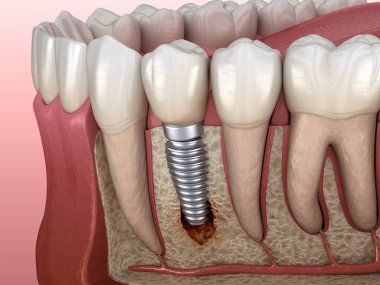 Görülebilir kemik hasarlı perisiplantit. Diş implantı kavramının tıbben doğru üç boyutlu çizimi