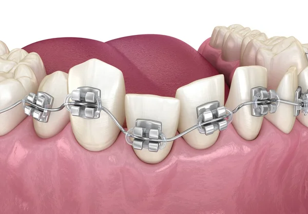 Onormal Tandställning Och Clear Tandställning Tretament Medicinskt Korrekt Dentala Illustration — Stockfoto