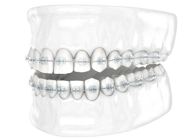 Dientes Frenos Transparentes Ilustración Dental Médicamente Precisa Concepto Estilo Blanco —  Fotos de Stock