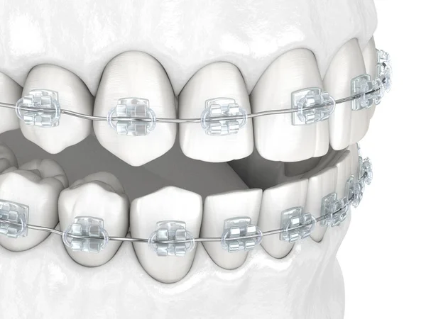 Зубы Прозрачные Брекеты Медицинская Точность Стоматологической Иллюстрации Концепция Белого Стиля — стоковое фото