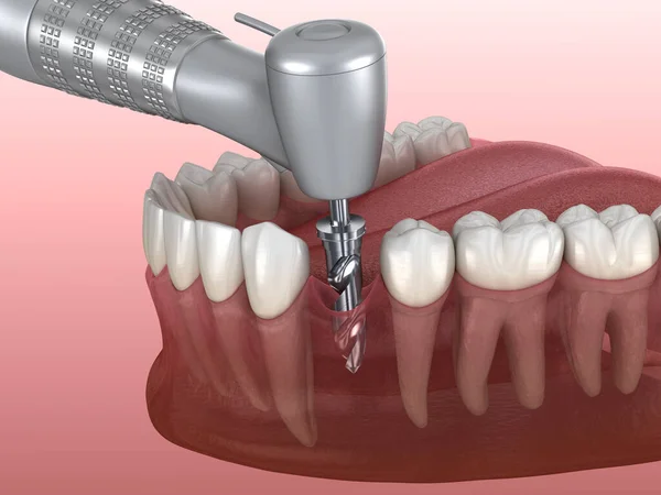 Wiercenie Kości Podczas Wszczepiania Implantu Dentystycznego Medycznie Dokładna Ilustracja Koncepcji — Zdjęcie stockowe