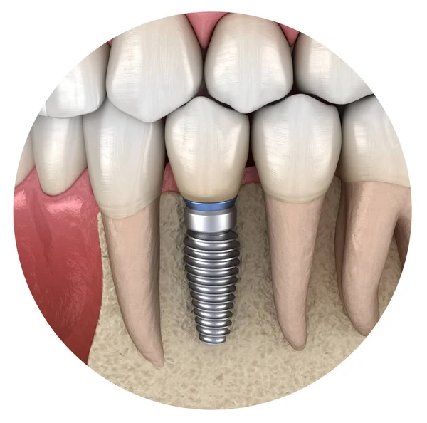 Premolaarinen Hampaiden Palautuminen Implantaatilla Lääketieteellisesti Tarkka Kuva Ihmisen Hampaat Tekohampaat — kuvapankkivalokuva