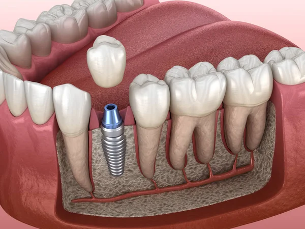 Premolar tooth crown installation over implant abutment. Medically accurate 3D illustration of human teeth and dentures concept