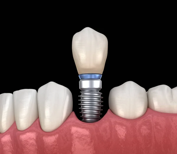 Récupération Prémolaire Des Dents Avec Implant Illustration Médicalement Précise Concept — Photo