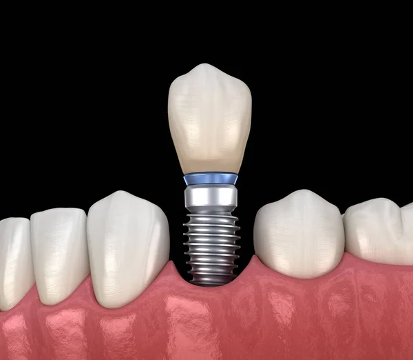 Recuperación Dental Preremolar Con Implante Ilustración Médicamente Precisa Del Concepto — Foto de Stock