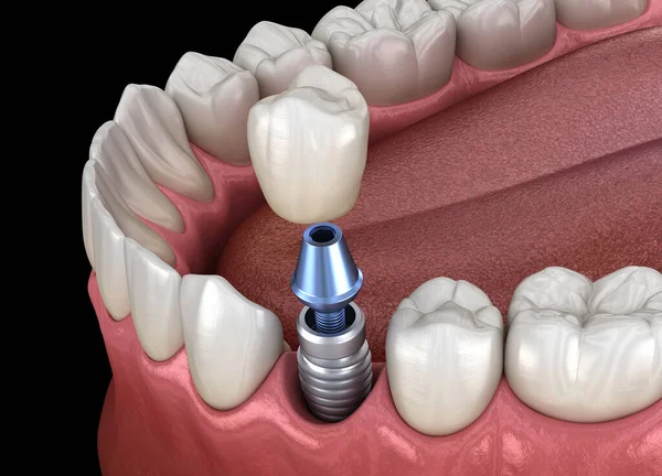 Odzyskiwanie Zębów Przedtrzonowych Implantem Medycznie Dokładna Ilustracja Koncepcji Ludzkich Zębów — Zdjęcie stockowe