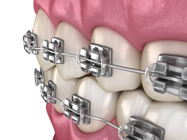 Braces Métalliques Tretament Vue Macro Illustration Dentaire Médicalement Précise — Photo