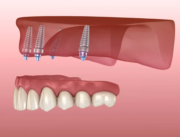 Prótesis Maxilar Con Encía Todo Sistema Soportado Por Implantes Ilustración — Foto de Stock