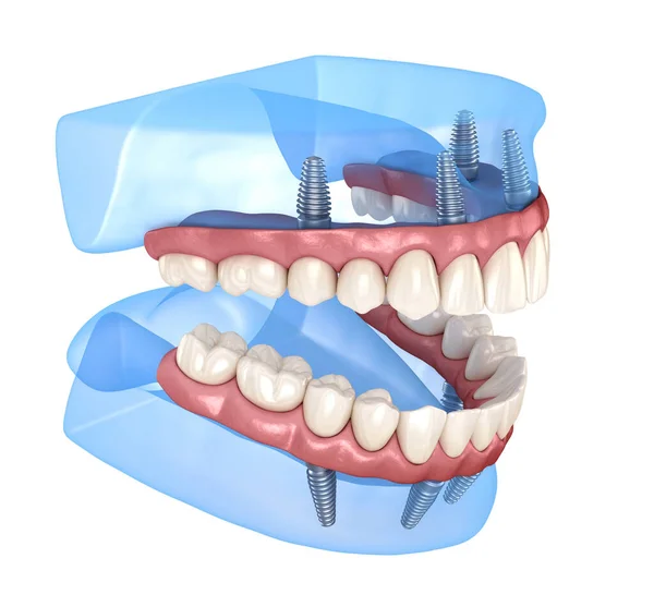 Protesi Maxillare Mandibolare Con Gengiva Tutto Sistemi Supportati Impianti Illustrazione — Foto Stock