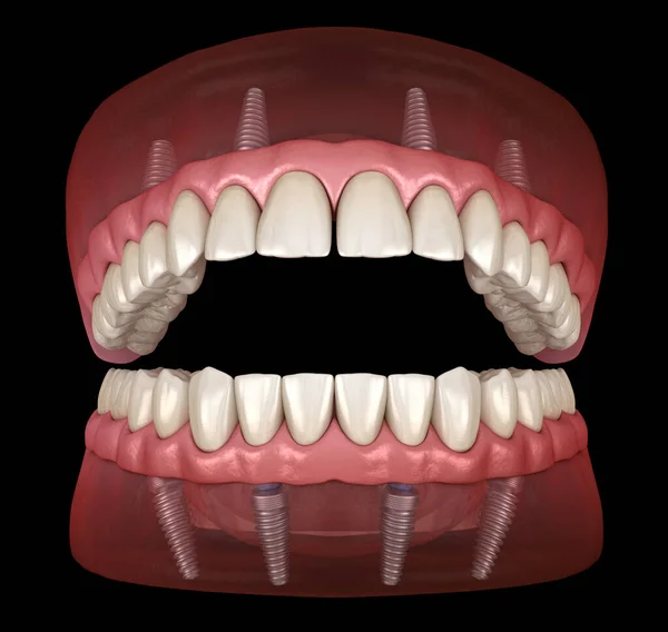 Çikletli Maxillary Mandibular Protez Hepsi Implantlarla Desteklenen Sistemde Nsan Dişlerinin — Stok fotoğraf