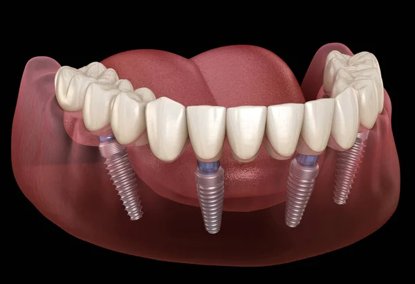 Prothèse Mandibulaire Tout Sur Système Soutenu Par Des Implants Illustration — Photo