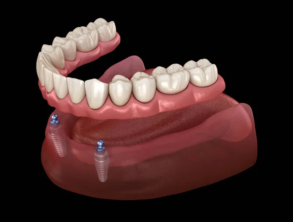 手動取り外し可能なプロテーゼボールの添付ファイルを持つインプラントによってサポートされている2システム上のすべて 医学的に正確な歯科3Dイラスト — ストック写真