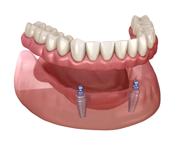 Mandibulär Löstagbar Protes Allt System Stöds Implantat Med Kulfästen Medicinskt — Stockfoto