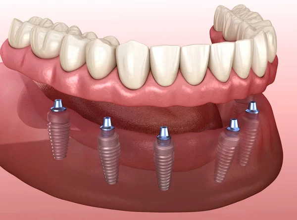 Unterkieferprothese Mit Zahnfleisch Alles Auf System Das Durch Implantate Unterstützt — Stockfoto