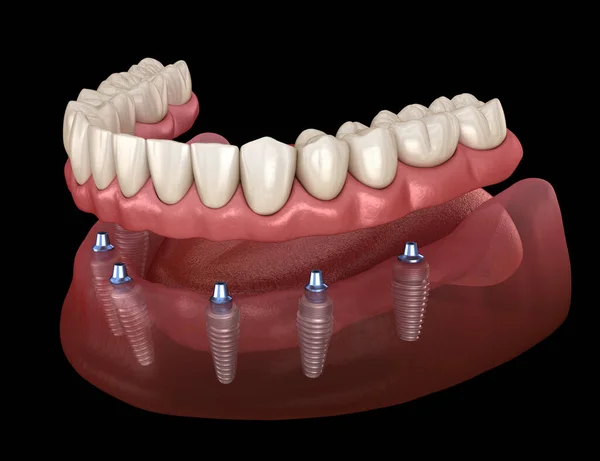 Prothèse Mandibulaire Tout Sur Système Soutenu Par Des Implants Illustration — Photo