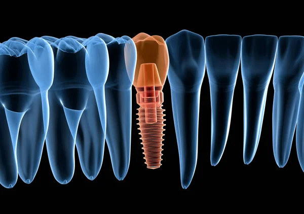 Fogpótlás Implantátummal Röntgenkép Orvosilag Pontos Illusztráció Emberi Fogak Műfogsor Koncepció — Stock Fotó