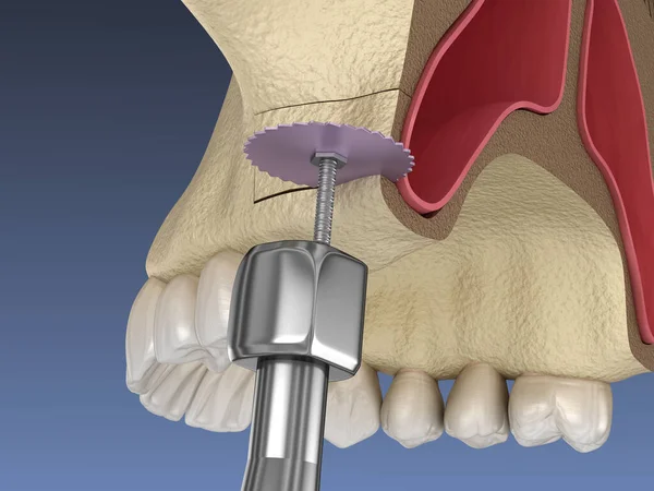 鼻窦升降外科 创造侧门进入鼻窦 3D插图 — 图库照片