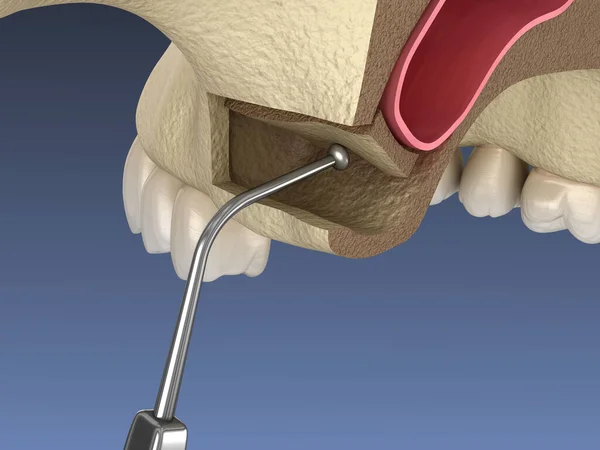 Sinus Lift Χειρουργική Μετακίνηση Μεμβράνη Κόλπων Απεικόνιση — Φωτογραφία Αρχείου