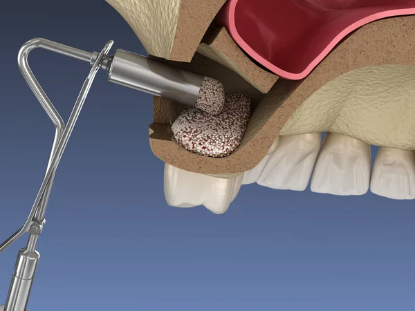 鼻窦升降外科 增加新的骨头 3D插图 — 图库照片