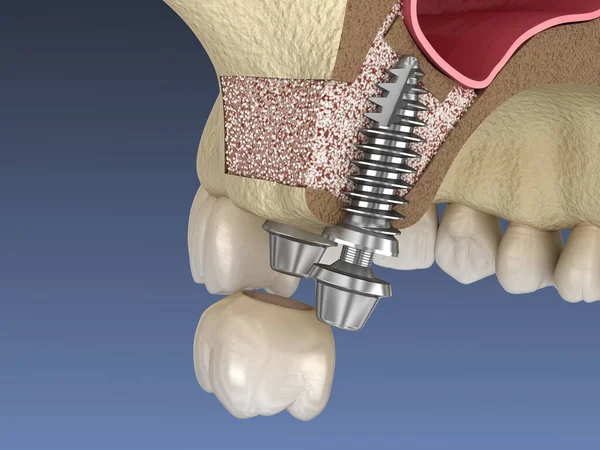 鼻窦升降外科 植入物安装 3D插图 — 图库照片