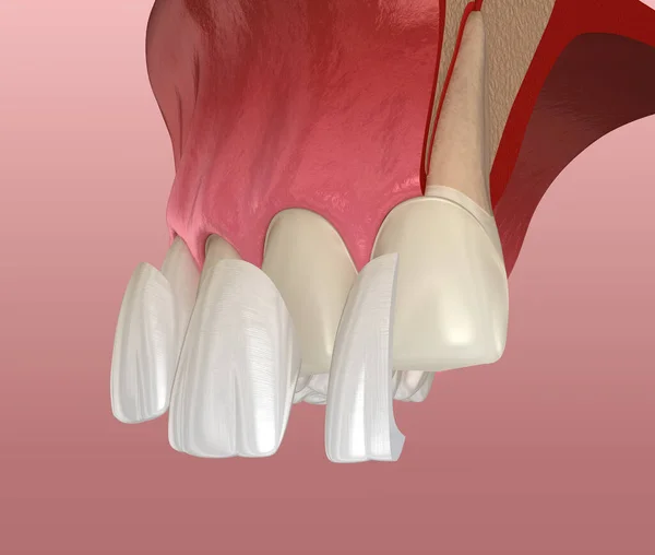 Veneer Installation Procedure Central Incisor Lateral Incisor Sliced View Illustration — Stock Photo, Image
