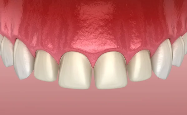 中央インジケータおよび側方インジケータに対するVeneer設置手順の歯の準備 医学的に正確な歯3Dイラスト — ストック写真