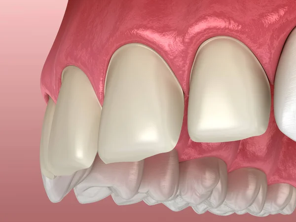 Preparação Dos Dentes Para Procedimento Instalação Folheado Sobre Incisivo Central — Fotografia de Stock