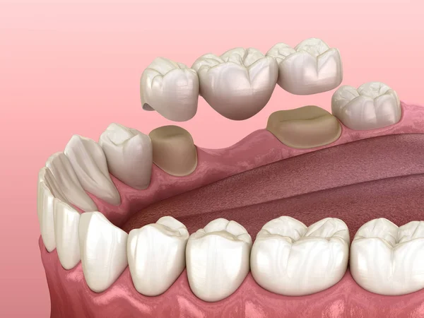 Ponte Dentária Dentes Sobre Molar Pré Molar Ilustração Medicamente Precisa — Fotografia de Stock