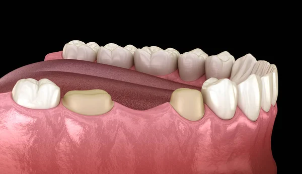 Preparated molar and premolar tooth for dental bridge placement. Medically accurate 3D illustration