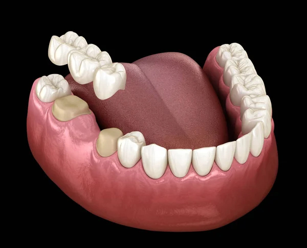 Pont Dentaire Dents Sur Molaire Prémolaire Illustration Médicalement Précise Traitement — Photo