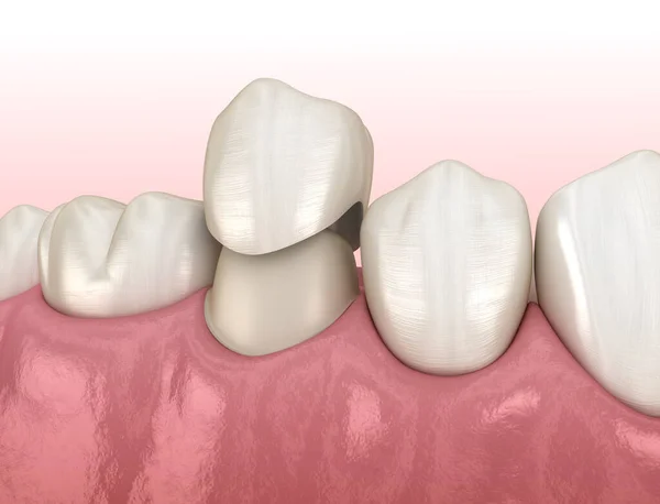 Colocación Dientes Premolares Corona Dental Preparada Ilustración Médicamente Precisa — Foto de Stock