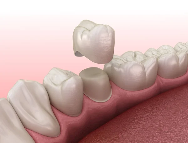 前臼歯と歯冠の配置を準備しました 医学的に正確な3Dイラスト — ストック写真