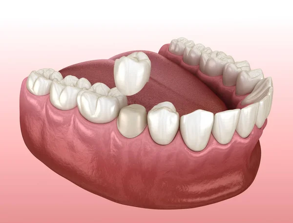 Préparation Dent Prémolaire Placement Couronne Dentaire Illustration Médicalement Précise — Photo