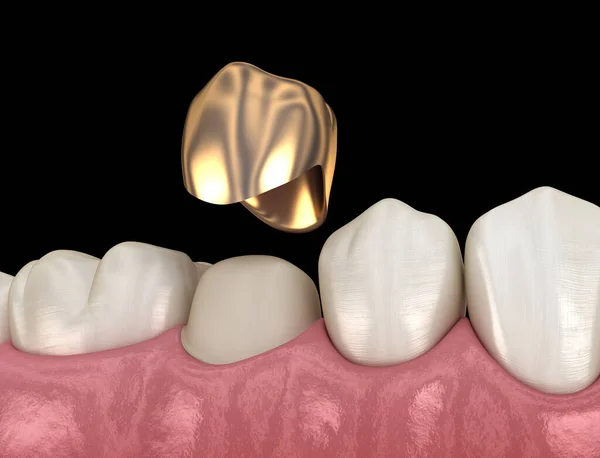 Processo Montagem Dentes Pré Molares Coroa Dourada Ilustração Medicamente Precisa — Fotografia de Stock