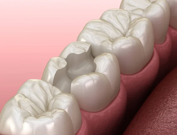Inlay Keramische Kroon Fixatie Tand Medisch Nauwkeurige Illustratie Van Behandeling — Stockfoto
