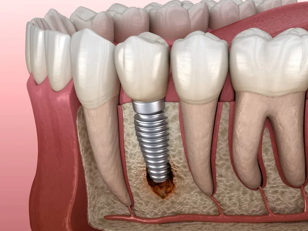 Periimplantitida Viditelným Poškozením Kostí Lékařsky Přesná Ilustrace Konceptu Zubních Implantátů — Stock fotografie