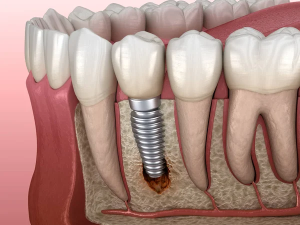 Periimplantite Com Lesão Óssea Visível Ilustração Medicamente Precisa Conceito Implantes — Fotografia de Stock