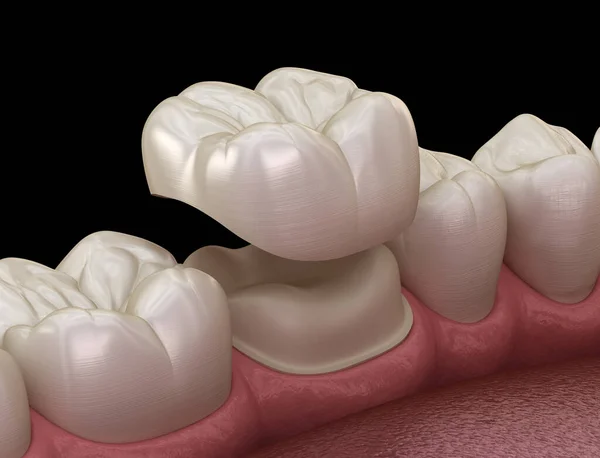 Підготовлений Молярний Зуб Розміщення Зубної Коронки Медично Точна Ілюстрація — стокове фото