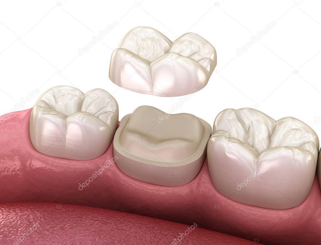 Preparation for Onlay ceramic crown fixation over tooth. Medically accurate 3D illustration of human teeth treatment