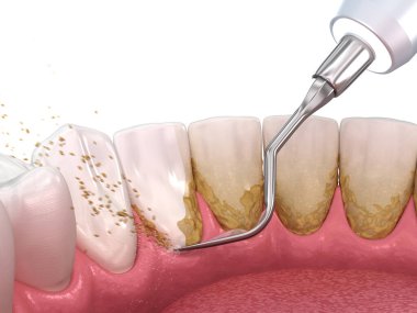 Ağız temizliği: Ölçekleme ve kök planlama (geleneksel periodontal terapi). İnsan diş tedavisinin tıbbi açıdan doğru üç boyutlu çizimi