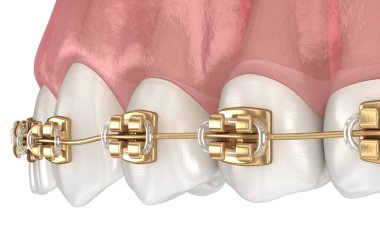 Altın diş telleri, makro manzara. Tıbbi olarak doğru olan 3 boyutlu diş illüstrasyonu