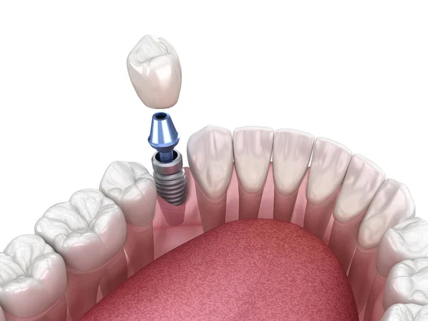 Premolární Zotavení Zubů Implantátem Lékařsky Přesná Ilustrace Konceptu Lidských Zubů — Stock fotografie