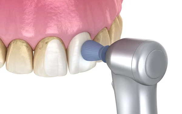 Procedimiento Pulido Dientes Con Cepillo Gel Profesional Ilustración Médicamente Precisa —  Fotos de Stock